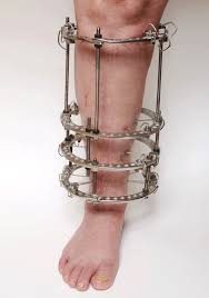Limb Reconstruction