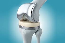Joint Replacement