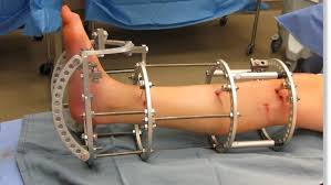 Limb Lengthening Surgery